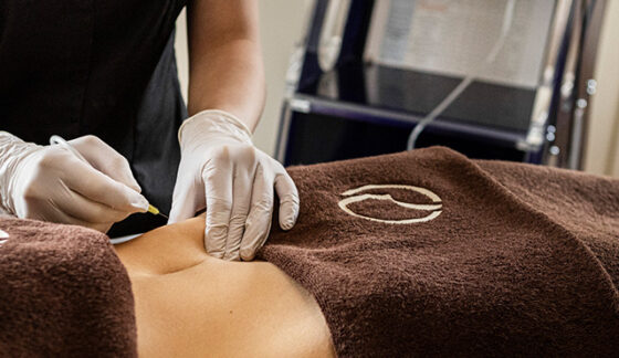 Karboksyterapia – nowatorski zabieg