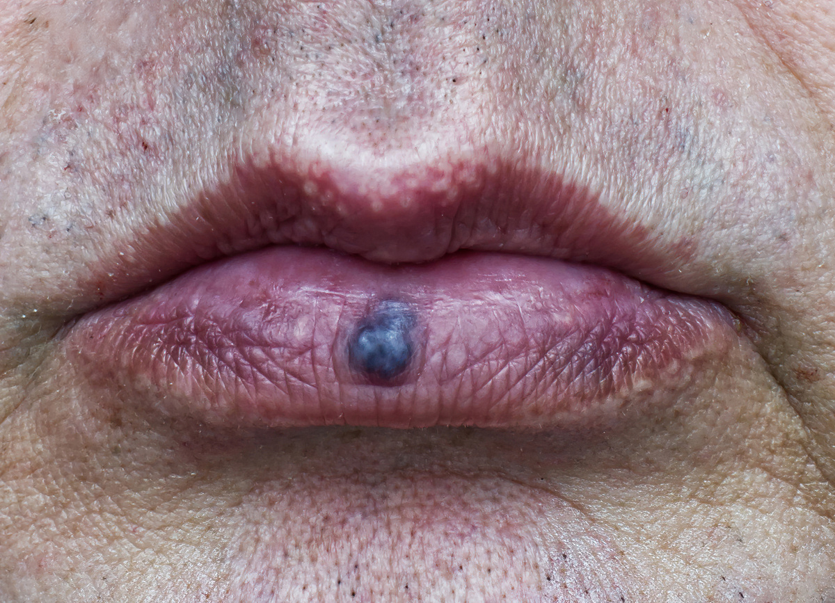 Jeziorki żylne na wargach