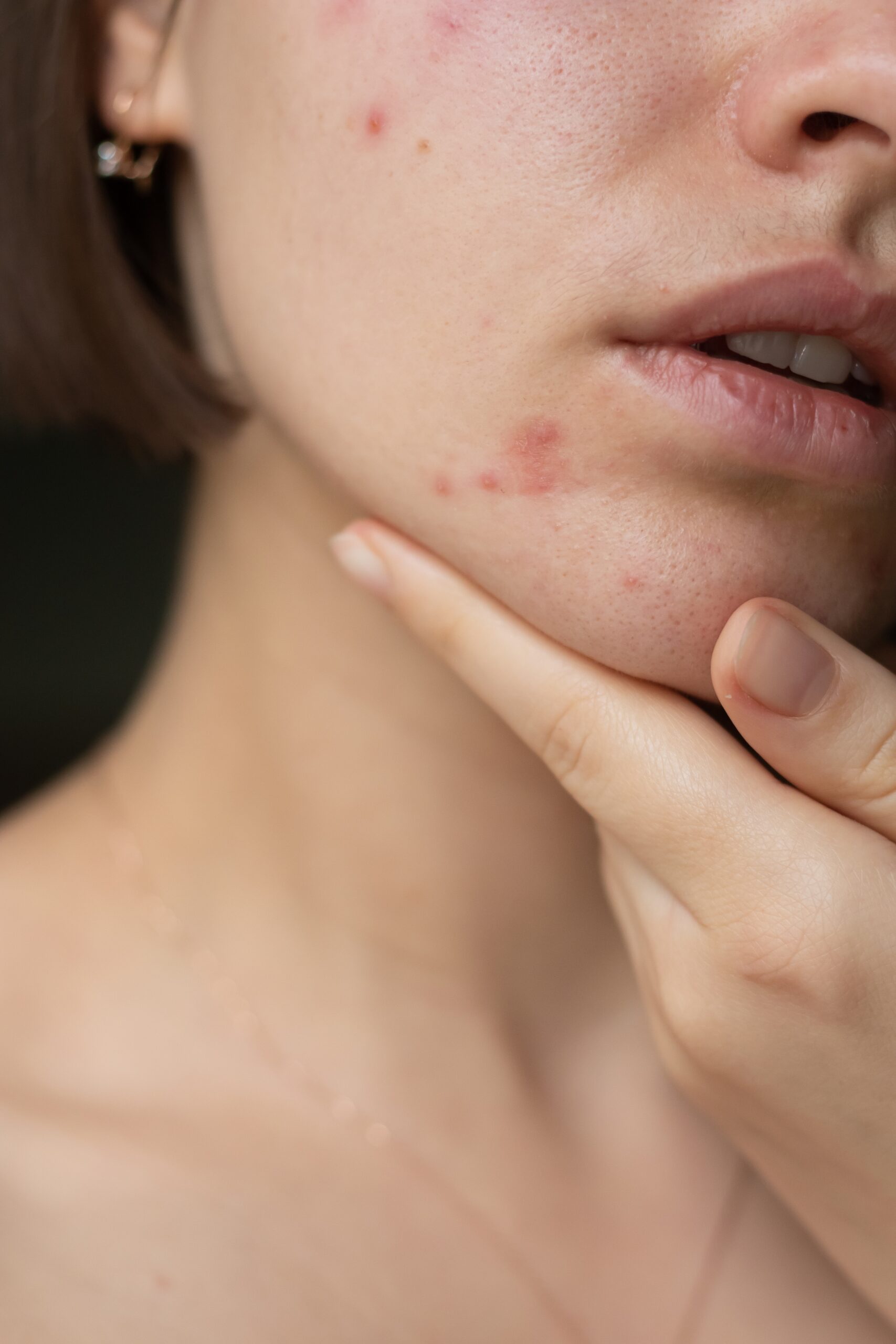 Peeling kwasem pirogronowym - zmniejszenie wyprysków i stanów zapalnych